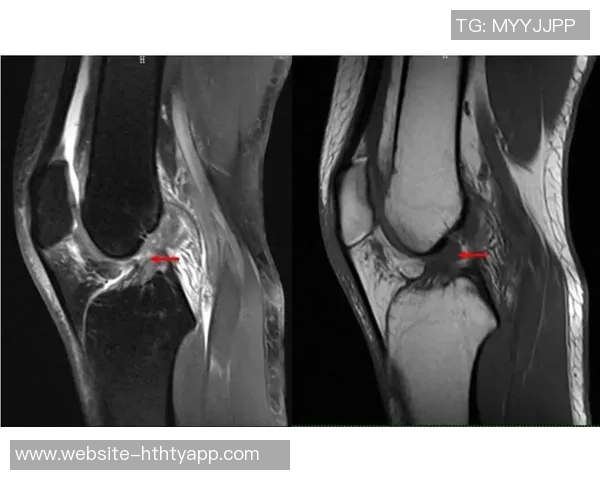 马德里竞技官方宣布朗格莱遭遇重度内侧副韧带扭伤无其他损伤